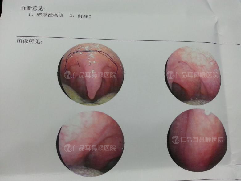 张先生咽部ct检测:肥厚性咽炎以及悬雍垂较长.